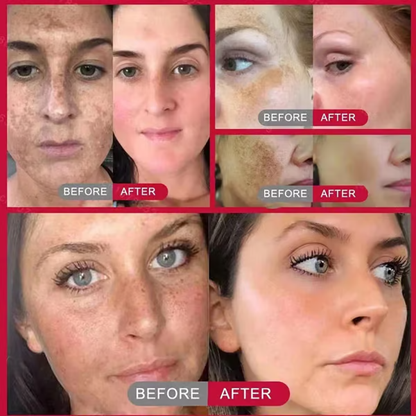 🔥Vitamin C Whitening Freckles Face Cream Remove Melasma Dark Spots Lighten Melanin