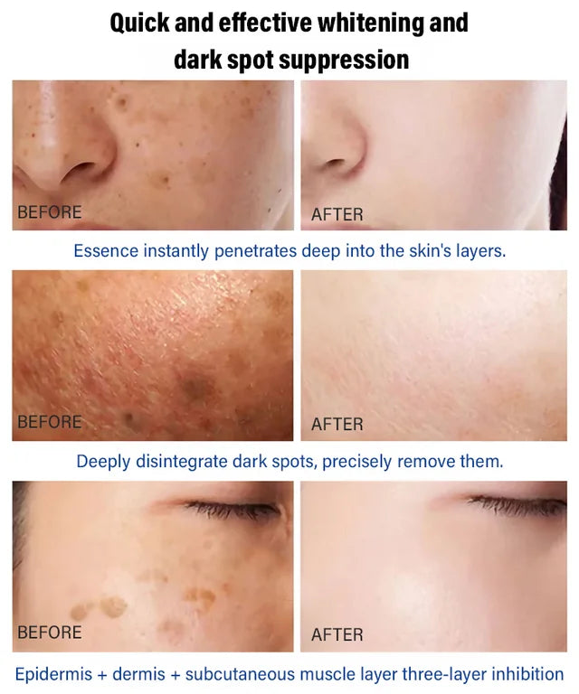 🔥Buy more save more🔥Freckle-Banishing Serum for Face: Repair and Cleanse Dark Spots
